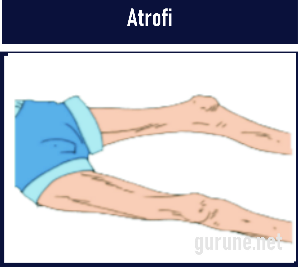 Artrofi adalah Kelainan otot yang mengecil, lemah, fungsi otot yang menurun. Hal ini disebabkan adanya penyakit polimielitis yang dapat merusakkan sel saraf pada otot.