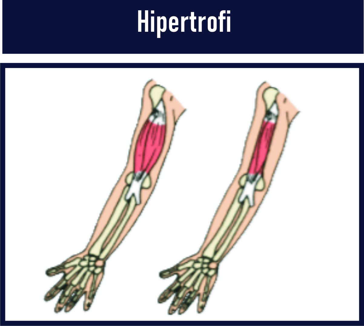 hipertrofi adalah Kelainan otot yang membesar dan menjadi lebih kuat karena sel otot diberikan kegiatan/aktivitas yang terus-menerus secara berlebihan.