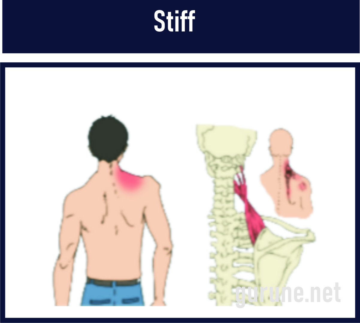 Stiff/kaku leher adalah Kelainan otot karena adanya peradangan otot trapesius leher akibat gerakan yang menghentak secara tiba-tiba/salah gerak.