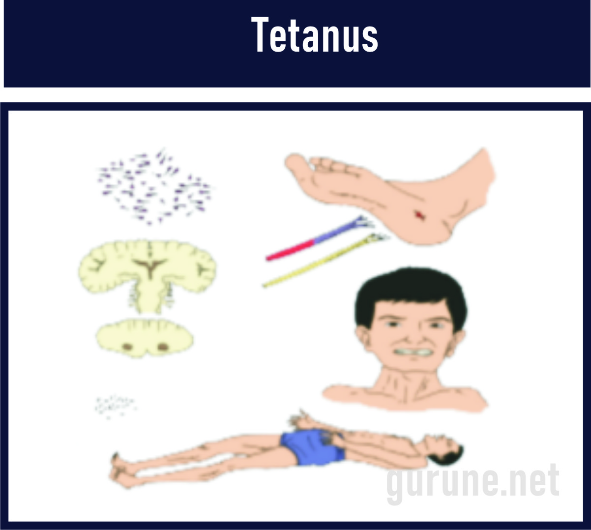 Tetanus adalah Kelainan otot yang disebabkan adanya infeksi bakteri Clostridium tetani. Tetanus menyebabkan otot menjadi kejang-kejang.
